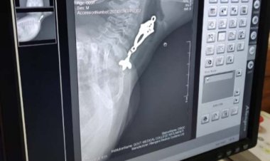 मेडिकल कालेज की उपलब्धि:आठ माह का बच्चा कान का झुमका निगल गया, मेडिकल कालेज में सफल सर्जरी कर निकाला -आपरेशन के बाद बच्चे की स्थिति बेहतर हुई, आहार नली में अटक गया था झूमका